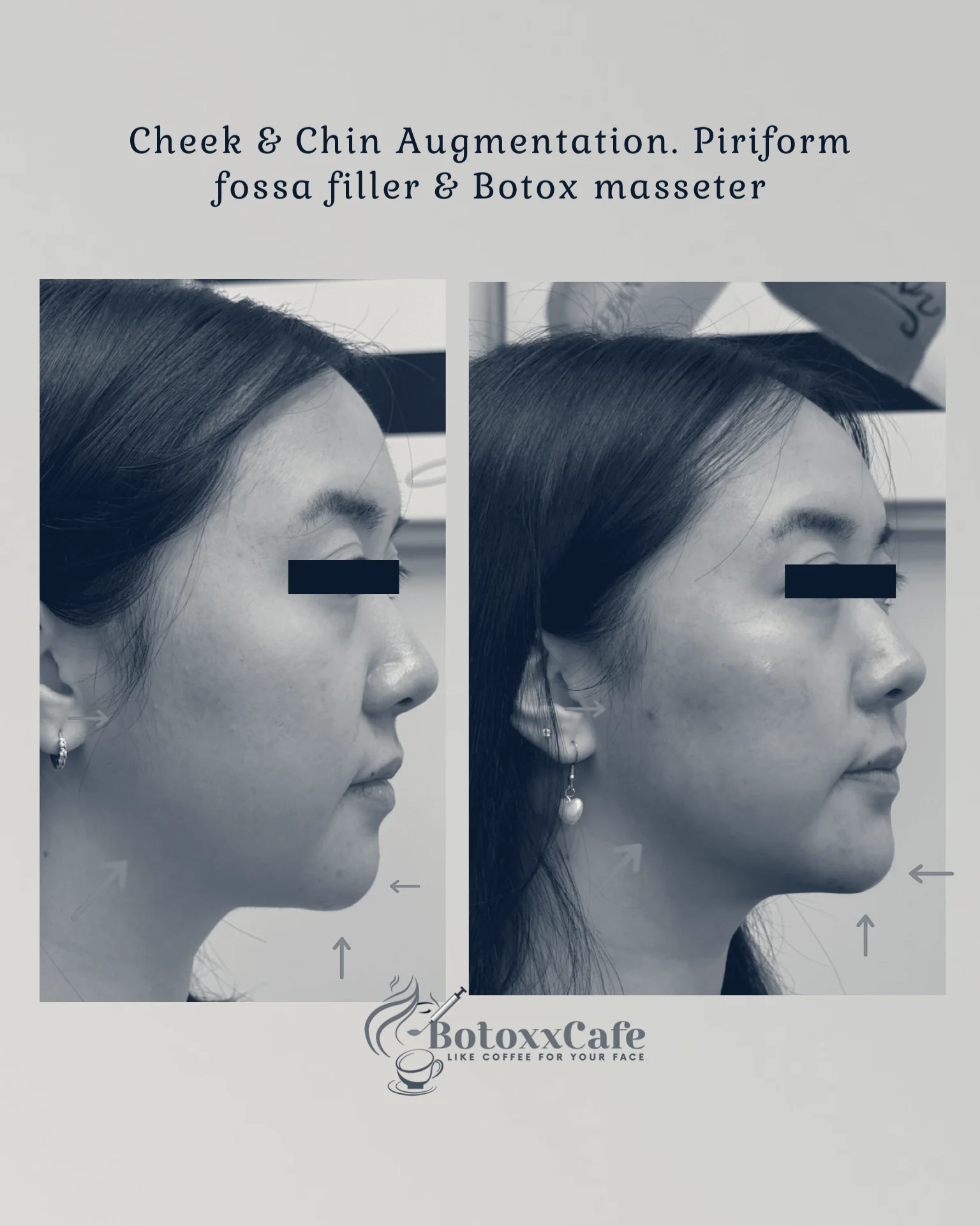 BotoxxCafe' Med Spa — Santa Clara, California