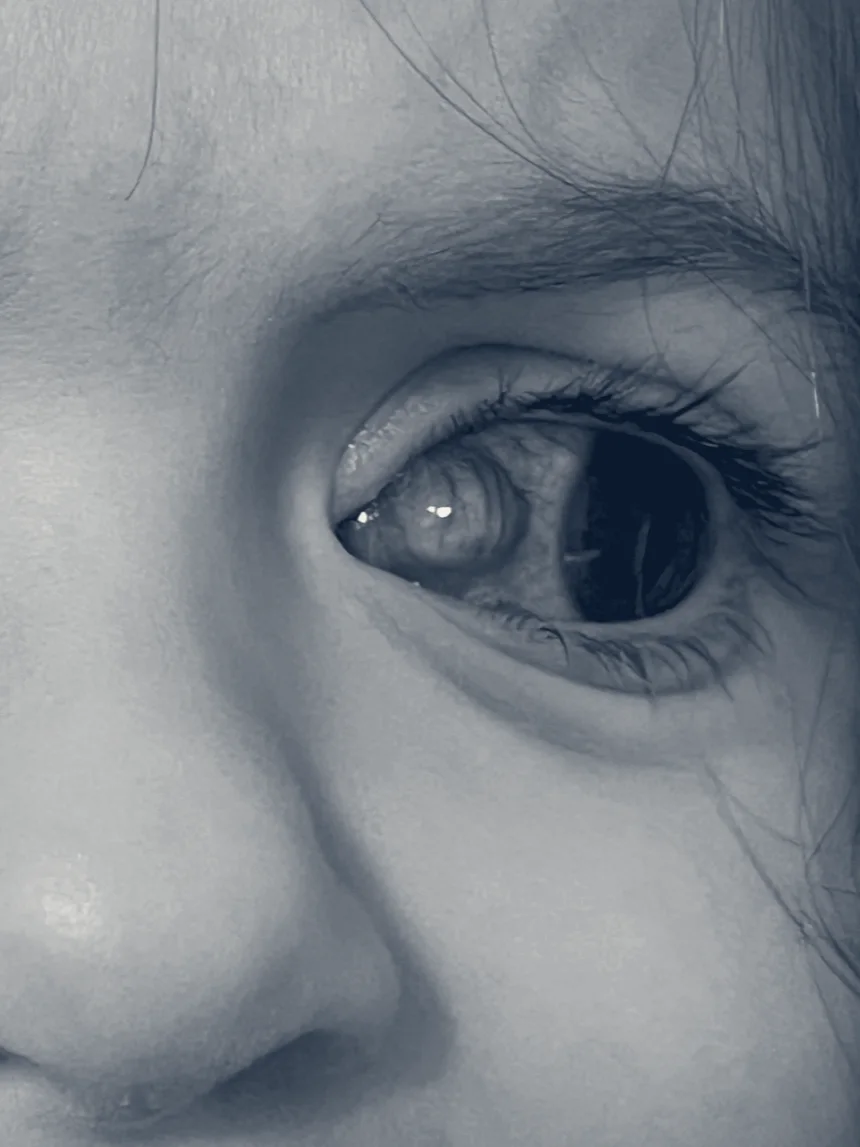 Pediatric Ophthalmology Strbsms — East Greenwich, Rhode Island
