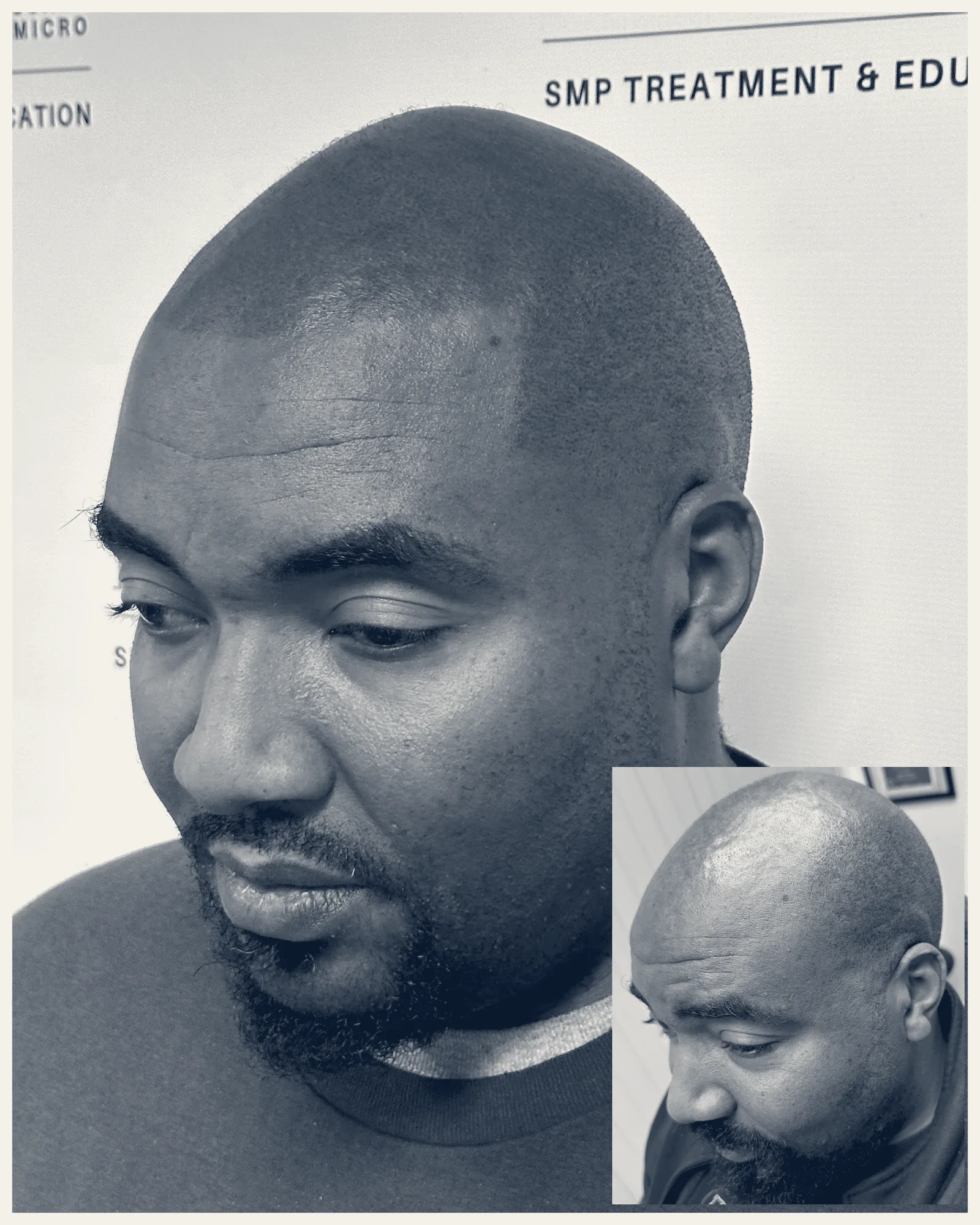 Precise Scalp Micropigmentation Service & Training in Rancho Cucamonga CA — Rancho Cucamonga, California