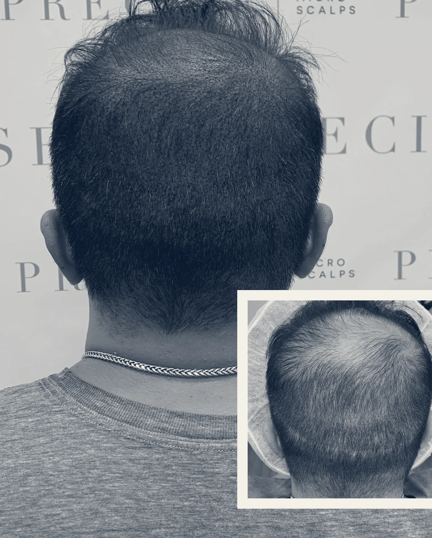 Precise Scalp Micropigmentation Service & Training in Rancho Cucamonga CA — Rancho Cucamonga, California