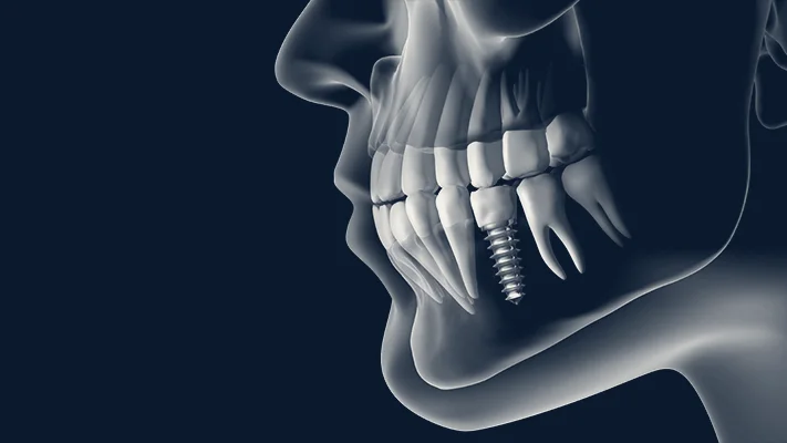 Dental Implants Institute of The West Coast — Santa Ana, California