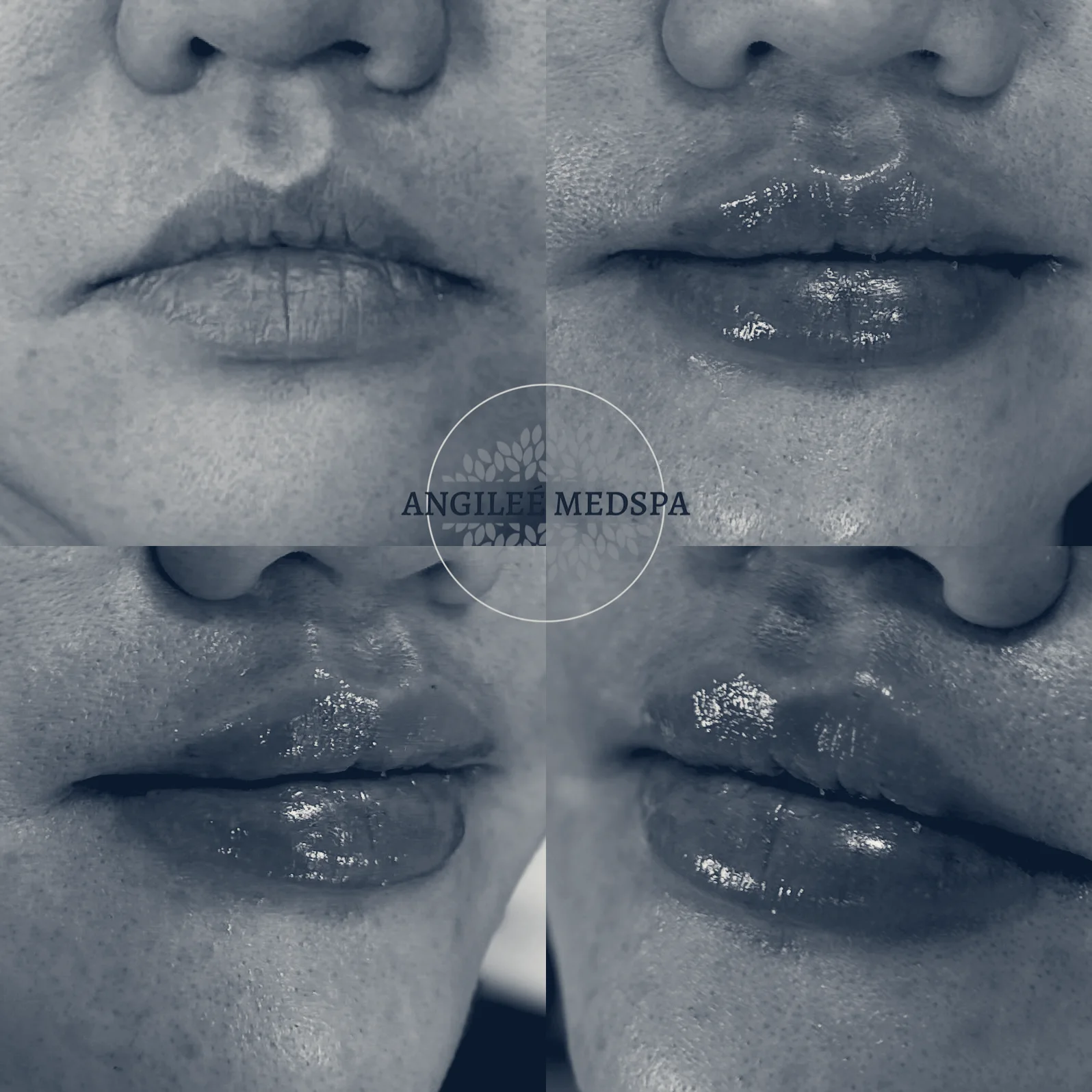 Angileé Med Spa — Long Beach, California