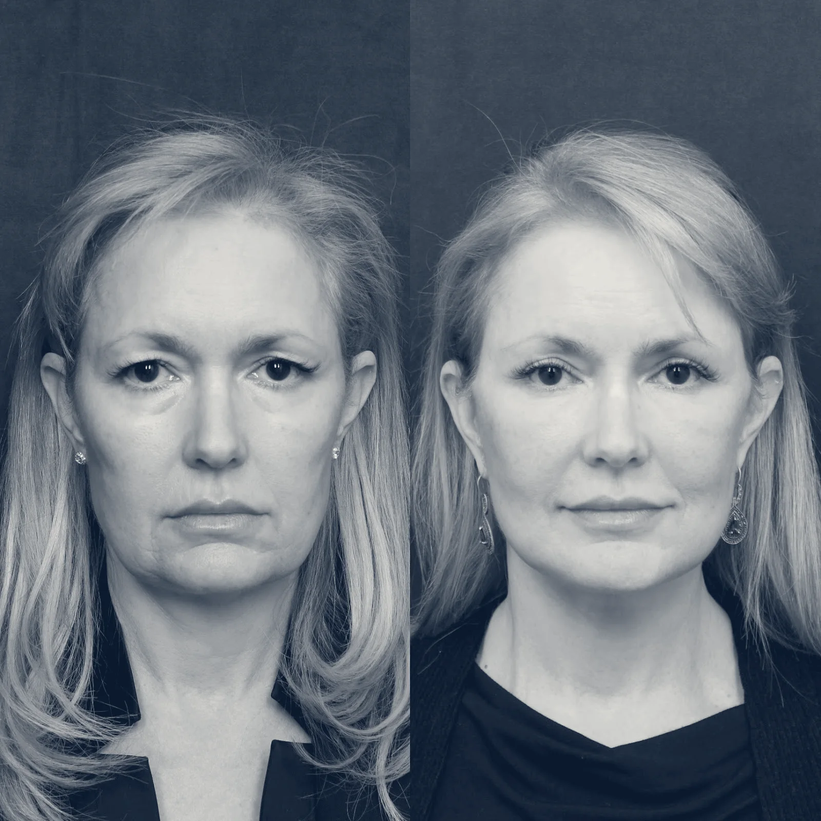 Dr. William Harris - Harris Facial Plastic Surgery & Aesthetics — Beverly Hills, California