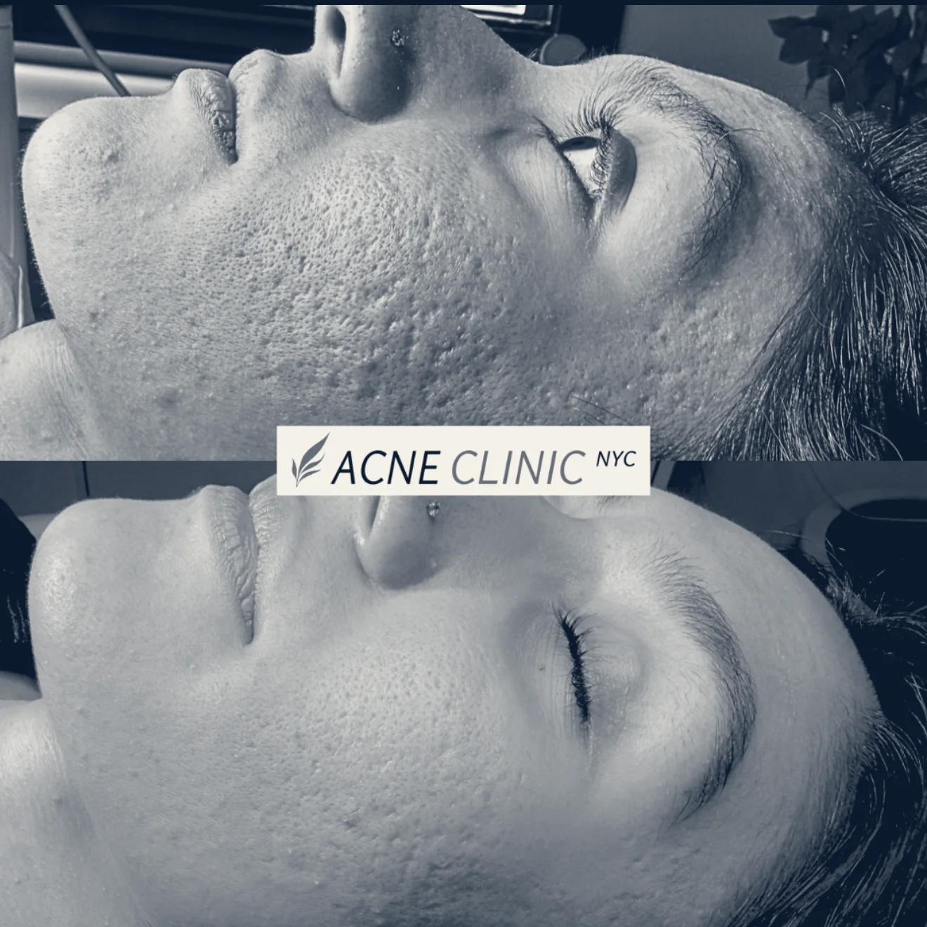 Acne Clinic NYC: Acne & Scars Treatment — New York, New York